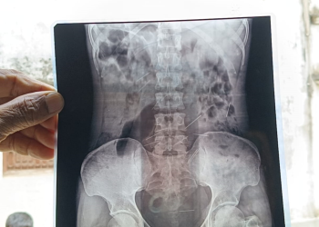 জীবন্ত মানুষের শরীরে অসংখ্য সুচ বা সিরিঞ্জ